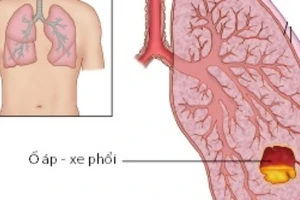 Cảnh báo áp-xe phổi ở trẻ tái xuất