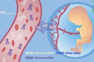 Xét nghiệm sàng lọc trước sinh NIPT được nhiều bà mẹ tin tưởng để sàng lọc hội chứng Patau. Ảnh: ITN