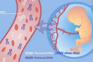 Xét nghiệm sàng lọc trước sinh NIPT được nhiều bà mẹ tin tưởng để sàng lọc hội chứng Patau. Ảnh: ITN