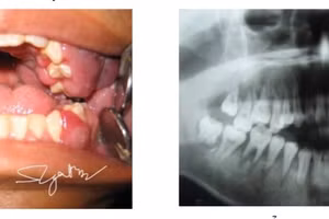 Các bác sĩ chẩn đoán bệnh nhân mắc leucemie cấp (ung thư máu cấp tính). Ảnh: BVCC