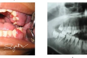 Các bác sĩ chẩn đoán bệnh nhân mắc leucemie cấp (ung thư máu cấp tính). Ảnh: BVCC