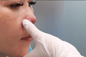 Một bệnh nhân biến chứng do tiêm filler nâng mũi. 