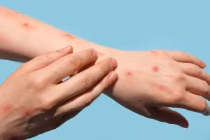 Người có HIV chưa kiểm soát được tình trạng bệnh có nguy cơ diễn biến nặng nếu mắc đậu mùa khỉ. Ảnh minh họa