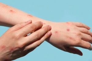 Người có HIV chưa kiểm soát được tình trạng bệnh có nguy cơ diễn biến nặng nếu mắc đậu mùa khỉ. Ảnh minh họa