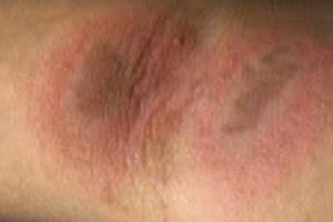 Tổn thương da do tiếp xúc kiến ba khoang.