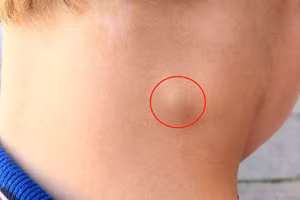 3 dấu hiệu bất thường trên cổ cảnh báo khối u đang phát triển,