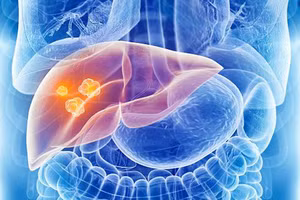 9 nhóm người có nguy cơ bị ung thư cao nhất