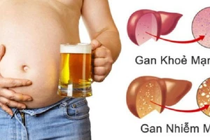 Dấu hiệu gan nhiễm mỡ, nên đi khám ngay khi phát hiện