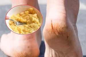 Bỏ túi cách trị nứt nẻ gót chân tại nhà cực kỳ hiệu quả