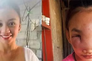 Thiếu nữ xinh đẹp mắc bệnh lạ sau khi nặn mụn