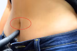 Mụn xuất hiện vị trí này có thể là dấu hiệu tế bào ung thư đã di căn