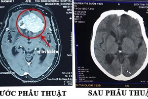 Hình ảnh trước và sau phẫu thuật của cụ bà 81 tuổi. (BVCC)