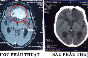 Hình ảnh trước và sau phẫu thuật của cụ bà 81 tuổi. (BVCC)