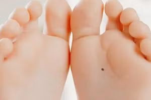 3 nốt ruồi khiến chủ nhân gặp nhiều may mắn, giàu có