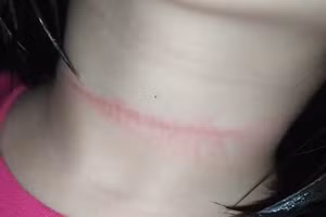 Vết hằn của sợ dây cuốn rèm cửa mà bé gái dùng để treo cổ.