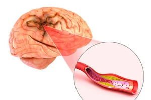 Đột quỵ não và vai trò của chụp cộng hưởng từ (MRI) trong tầm soát đột quỵ