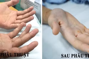 Bàn tay trước và sau phẫu thuật. (BVCC).