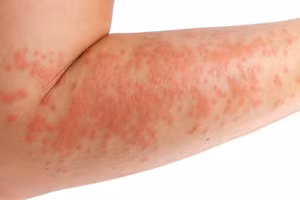 Những căn bệnh ngoài da không ai có thể tránh khỏi