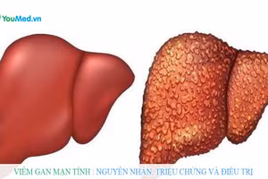 Viêm gan mạn tính.