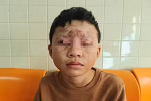 Nhiều vụ tai nạn liên quan đến học sinh chế tạo pháo nổ đã xảy ra.