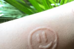 Emma mắc căn bệnh về da hiếm gặp.