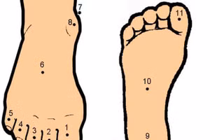 Nốt ruồi bàn chân có ý nghĩa gì?