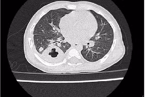 Ảnh X-quang tình trạng nhiễm khuẩn huyết, áp xe phổi do vi khuẩn Whitmore. Ảnh: Bệnh viện cung cấp.