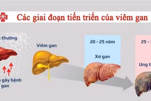 Cách phòng tránh ung thư gan 