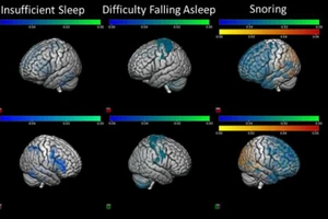 Các nhà khoa học đã phân tích dữ liệu hình ảnh về giấc ngủ và não từ hơn 5.500 trẻ.