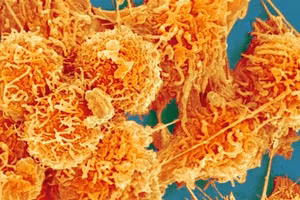 Những đợt sử dụng kháng sinh ngắn cũng có nguy cơ gây ung thư.