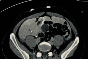 Hình ảnh chụp CT của bệnh nhân. Ảnh: BVCC.