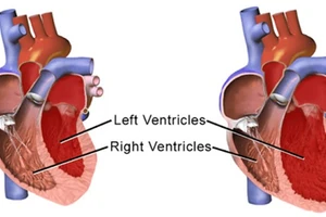 Bệnh DCM là nguyên nhân hàng đầu gây suy tim. Ảnh: ITN