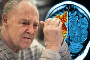 Người già dễ mắc bệnh Alzheimer.