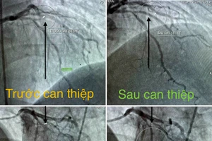 Bệnh viện Đa khoa Trung tâm An Giang cứu sống bệnh nhân người nước ngoài bị nhồi máu cơ tim cấp.