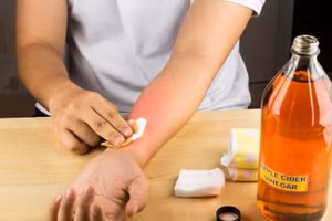 Dấm có thể trị được triệu chứng bỏng rát (hình minh họa).