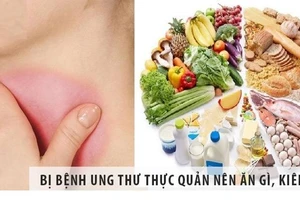 Ung thư thực quản đứng thứ 5 trong số các loại ung thư thường gặp.