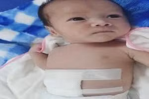 Sau phẫu thuật, hiện sức khoẻ bệnh nhi ổn định. Ảnh: BVCC.