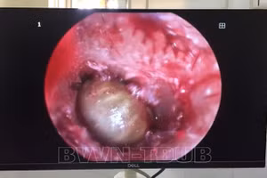 Hình ảnh ve chó trong tai bệnh nhi. Ảnh: BVCC.