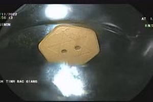 Viên đá 2 cm ở thực quản bệnh nhân. Ảnh: BVCC.