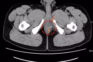 Dị vật ở trực tràng bệnh nhân. Ảnh: BVCC.