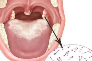 Hà Nội: Tăng cường công tác phòng chống tay chân miệng và bạch hầu