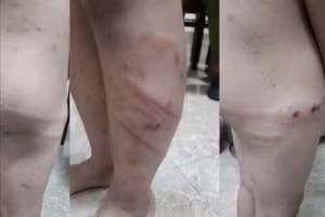 Những vết thương của cháu M nghi bị mẹ ruột và bạn trai của mẹ gây thương tích (ảnh: Xuân Nguyễn).