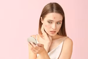 Mụn xuất hiện bởi nhiều yếu tố, bao gồm thay đổi nội tiết tố, căng thẳng và chế độ ăn uống kém. (Ảnh: ITN).