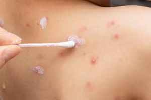 Mắc bệnh thủy đậu bao lâu thì khỏi?