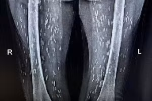 Kén sán dày đặc trên cơ thể bệnh nhân. Hình ảnh đã được làm mờ và thay đổi kích thước.