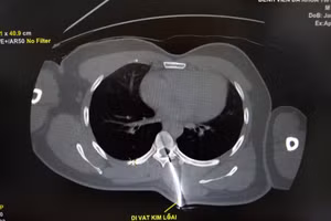 Hình dị vật kim loại trên phim CT ngực.