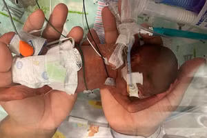 Em bé sinh non nhất thế giới.