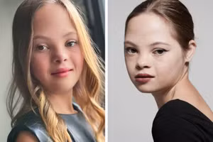 Cô bé bị bỏ rơi do mắc bệnh Down trở thành ngôi sao Hollywood