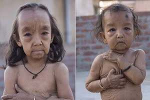 Hai chị em mắc chứng bệnh hiếm gặp.