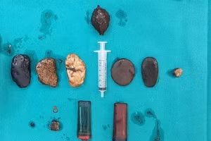 Dị vật được gắp ra từ dạ dày người bệnh.